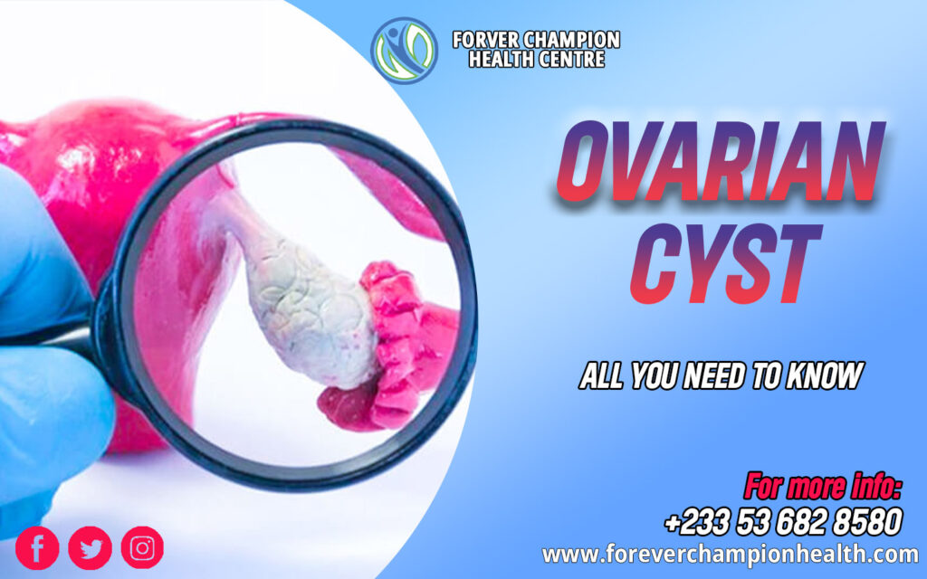 Ovarian cyst